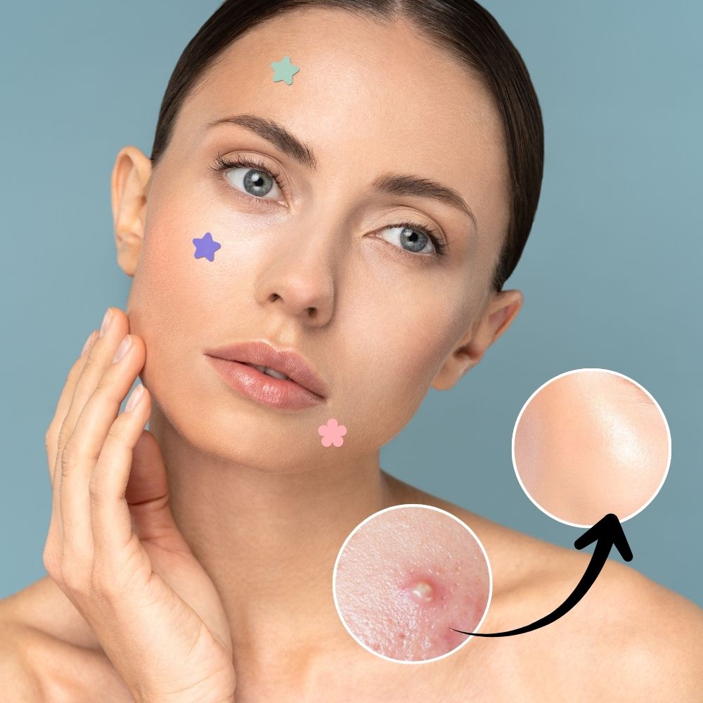 Hydrocolloid Pimple Acne Patch Sticker
