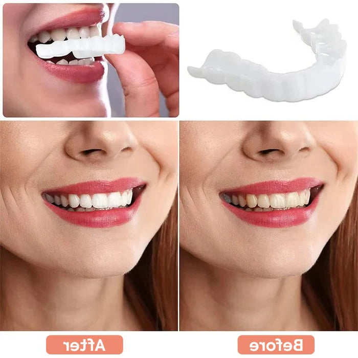 Veneers for Teeth with Natural White Finish